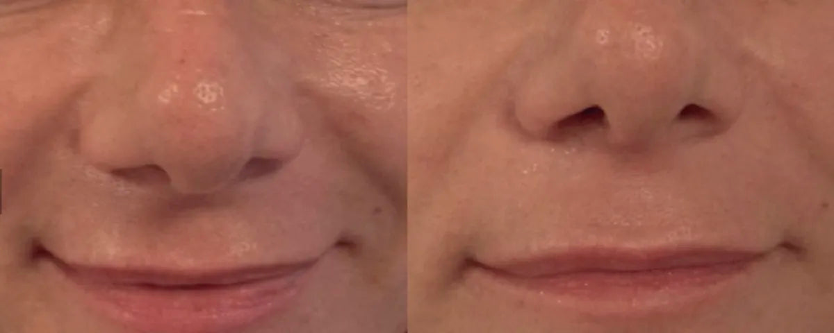 HIFU skin tightening before and after result 1 at Ora Skin