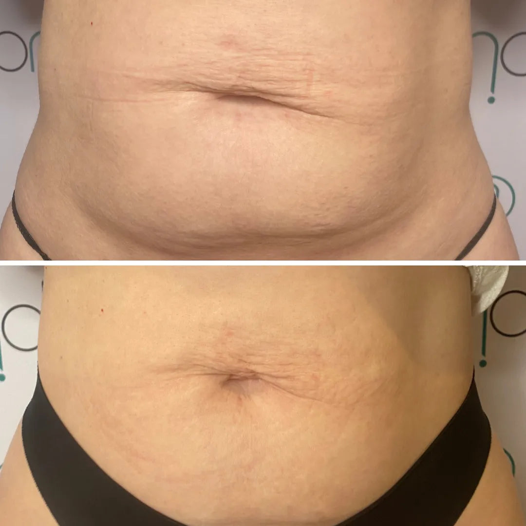 Onda body contouring before and after result 2 at Ora Skin
