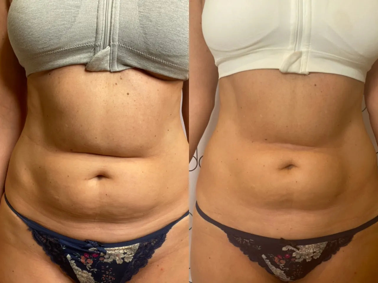 Onda body contouring before and after result 3 at Ora Skin