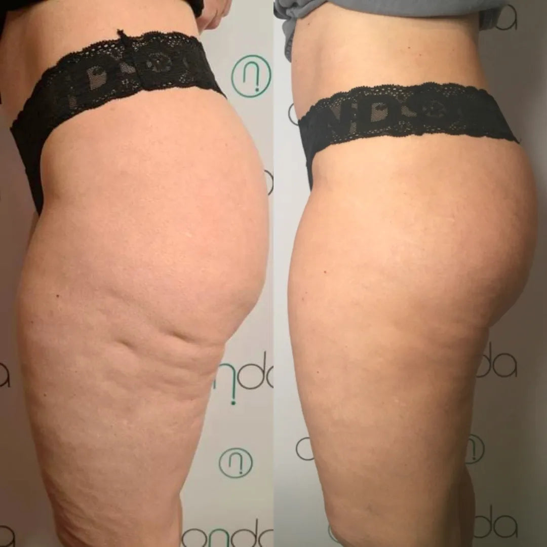 Onda body contouring before and after result 6 at Ora Skin