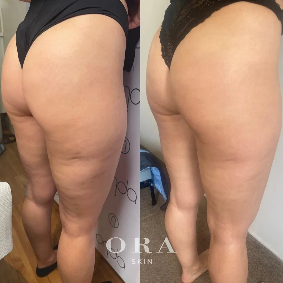 Onda body contouring before and after result 7 at Ora Skin